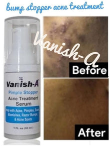  Vanish-A Bump Stopper Acne Serum 1 .oz - GoodBrands USA 